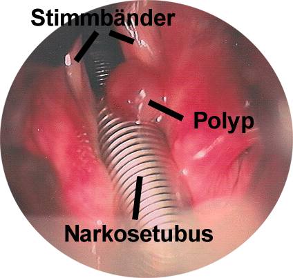 Stimmbandpolyp