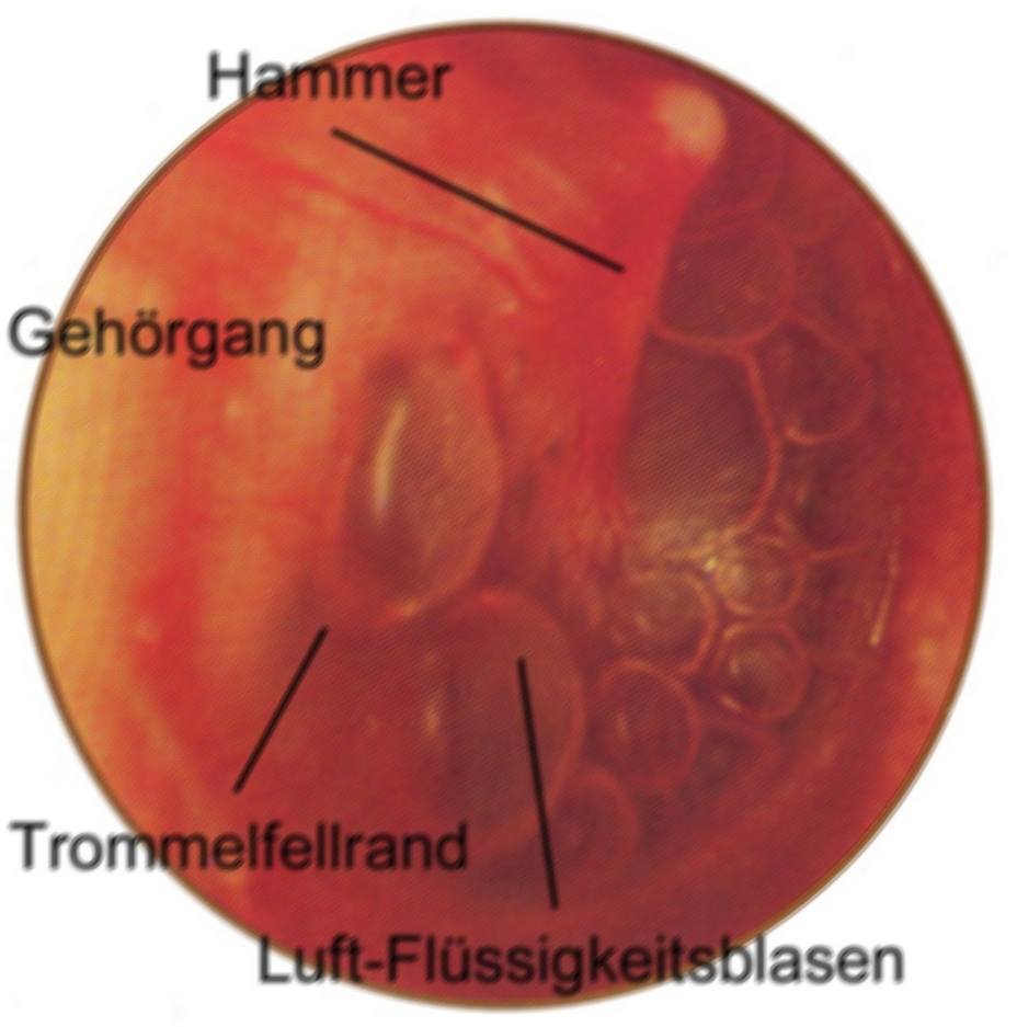 Paukenerguss