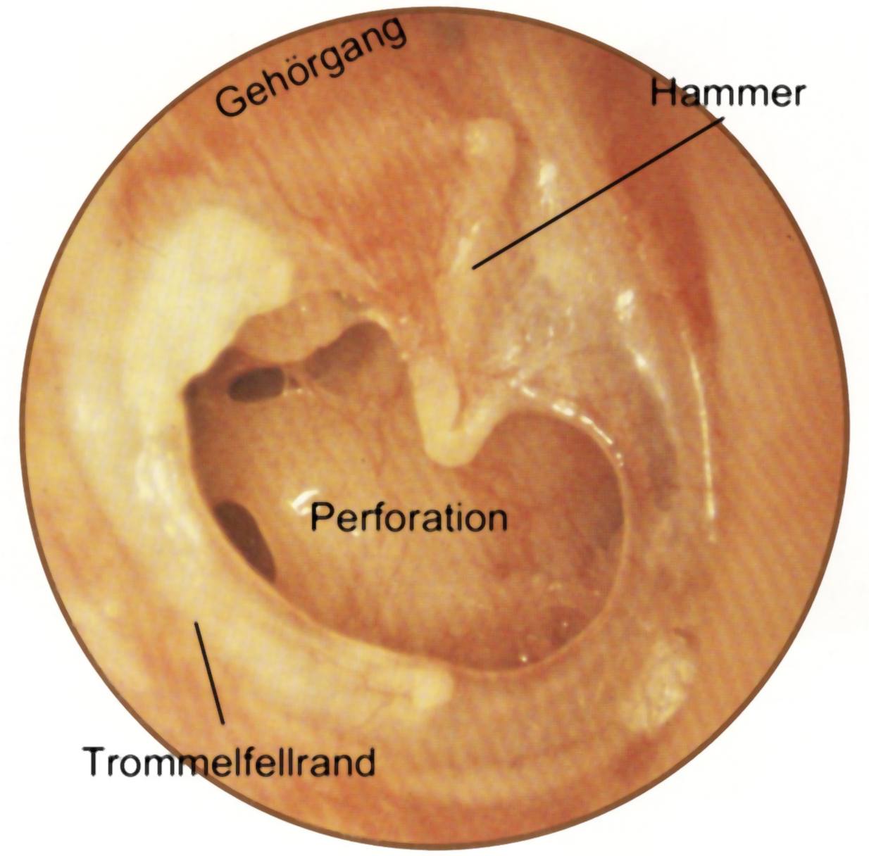 Trommelfellperforation