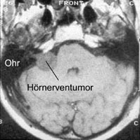 Vestibularisschwannom