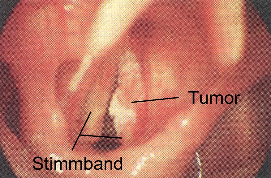 Stimmbandkarzinom