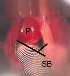 Stimmbandpolyp