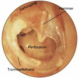 Chronische Otitis media