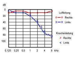 Reintonaudiogramm mit Schallempfindungsschwerhörigkeit