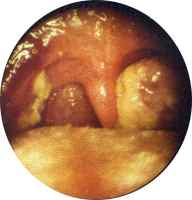 Tonsillitis bei Mononukleose (Pfeiffer'sches Drüsenfieber)