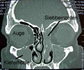 Chronische Sinusitis