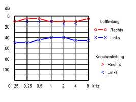 Reintonaudiogramm mit Schallleitungsschwerhörigkeit