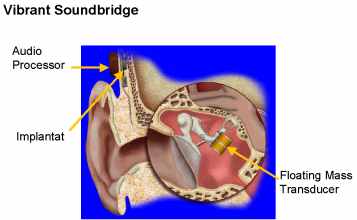 Vibrant Soundbridge